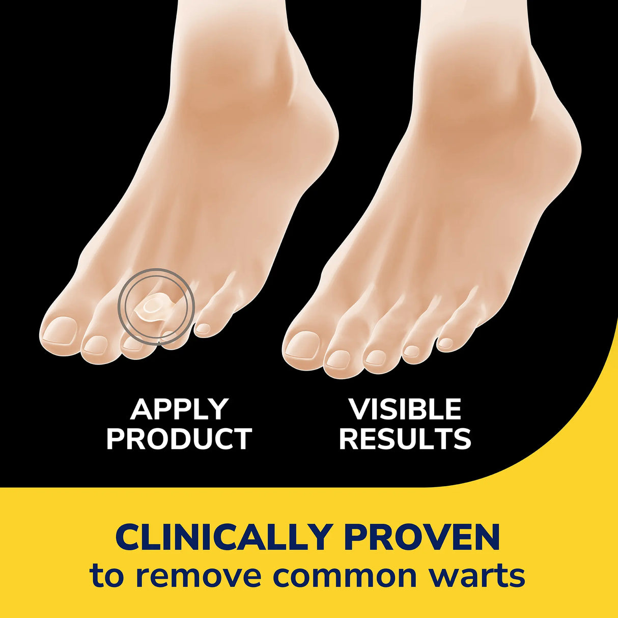 Clear Away® Wart Removers Seal & Heal Bandage with Hydrogel Technology