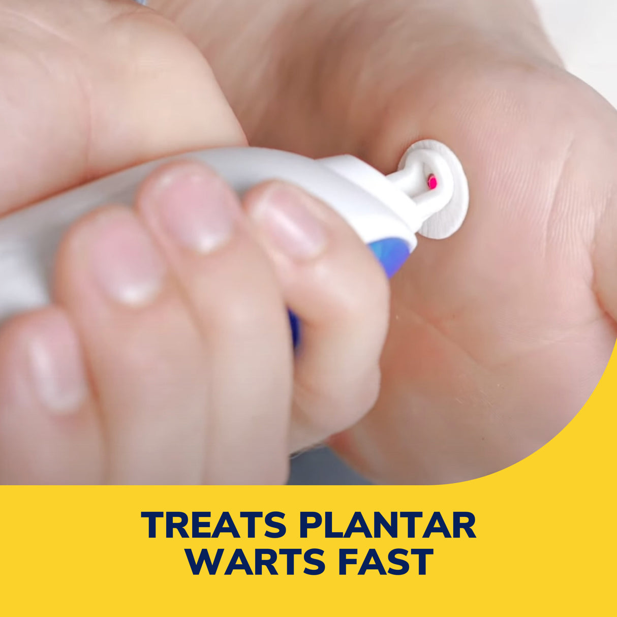 image of treats plantar warts fast