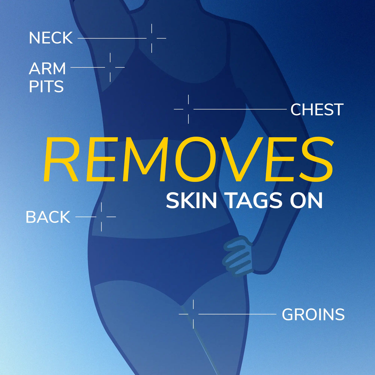 Body silhouette with marked areas showing where skin tags can be removed.