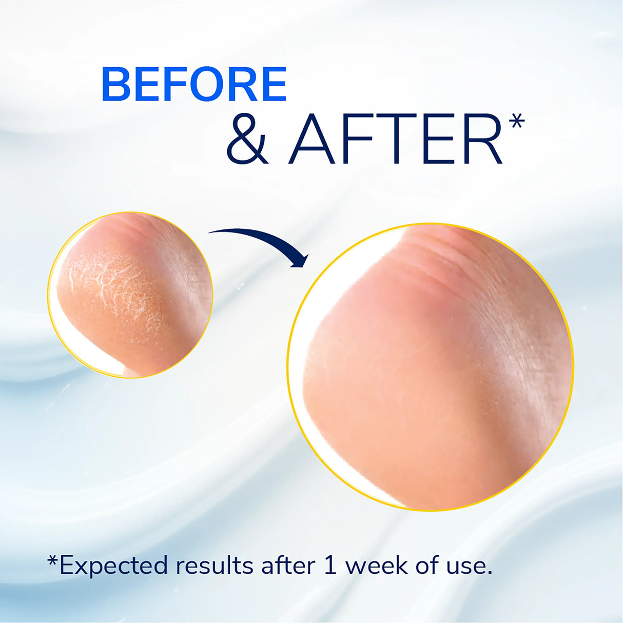 Severe Cracked Heel Repair Restoring Balm