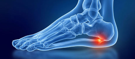 A foot in midstep demonstrating plantar fascia pain from plantar fasciitis.
