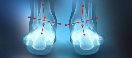 Rear-view illustration of two ankles with bone overlays and red alignment markers.