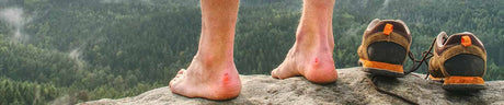image of foot blisters on hiker