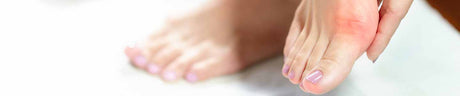 image of bunions on foot