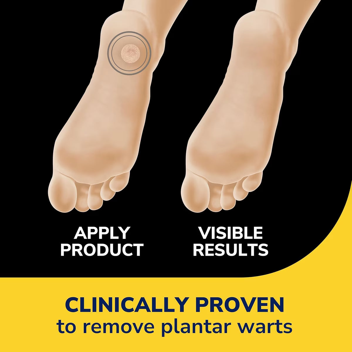 Clear Away® Plantar Wart Removers