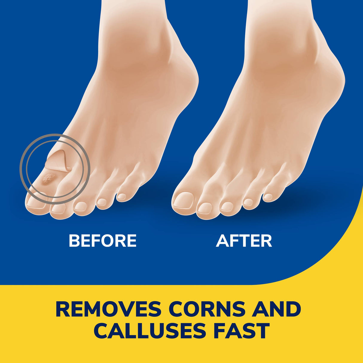 image of removes corns and calluses fast