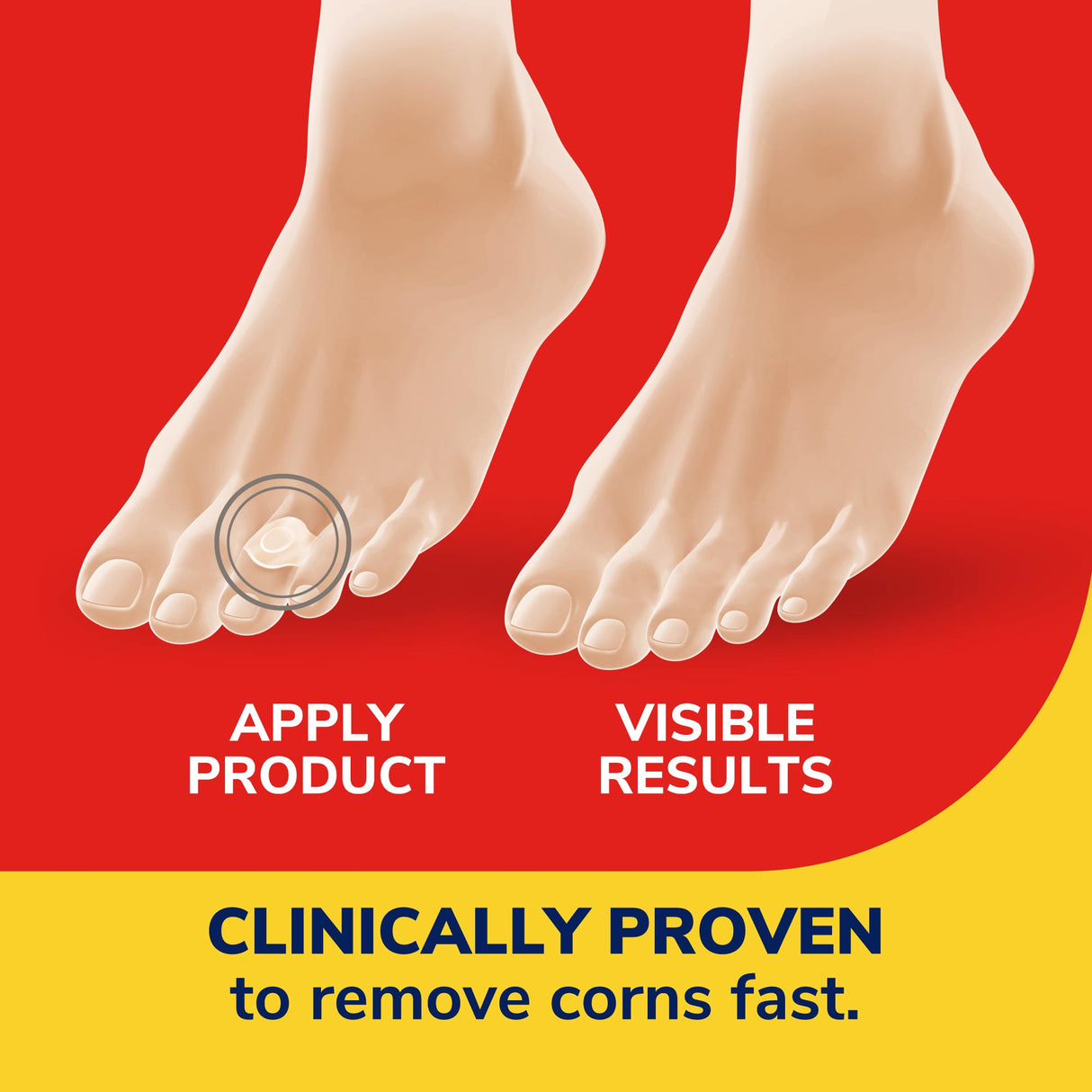 image of clinically proven to remove corns fast