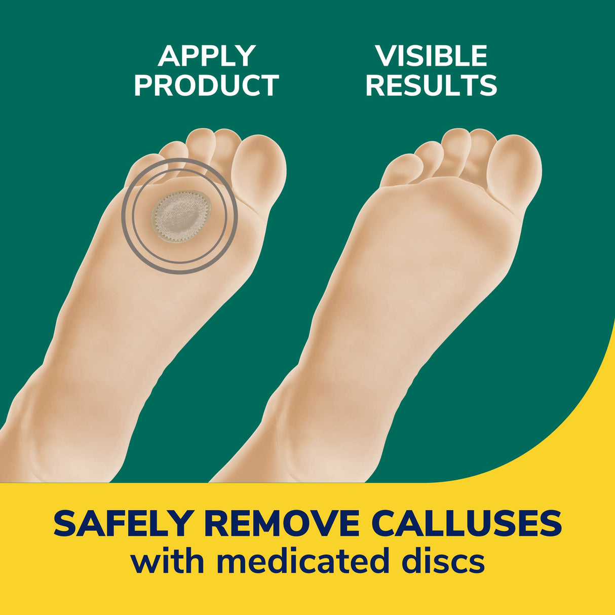 image of safely remove calluses with medicated discs