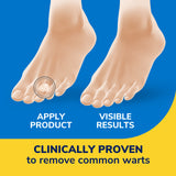 image of clinically proven to remove common warts