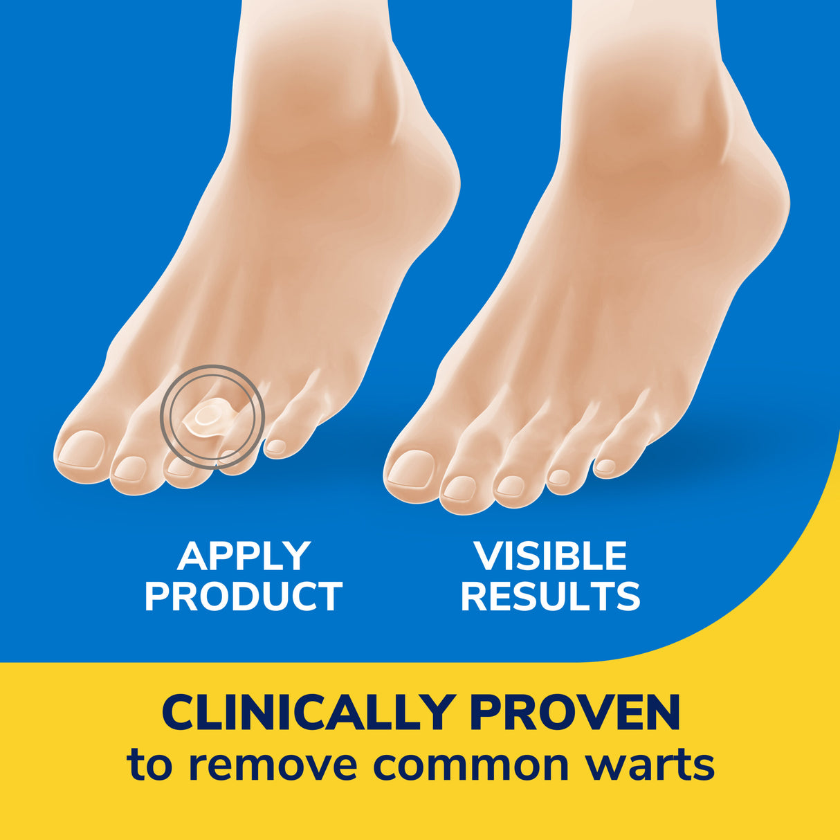 image of clinically proven to remove common warts