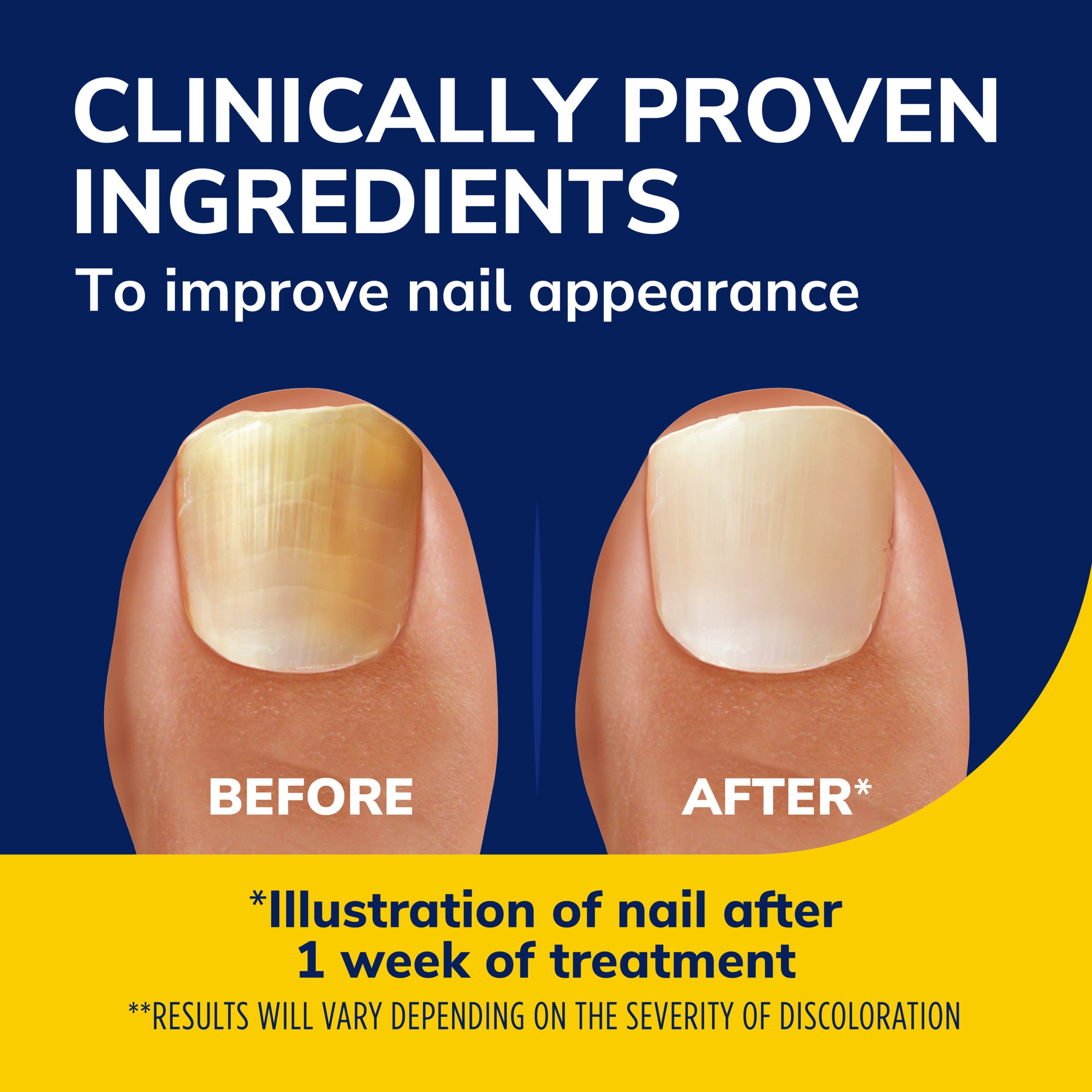 Nail fungus | NCH Healthcare System