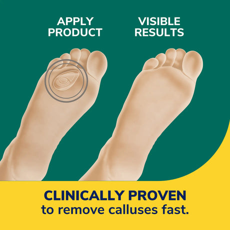 Callus remover seal & heal bandage on foot soles layout for visible results