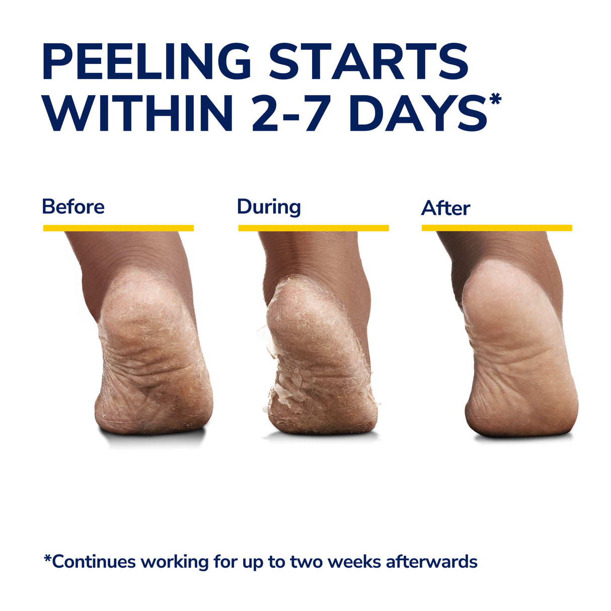 image of peeling starts within 2-7 days