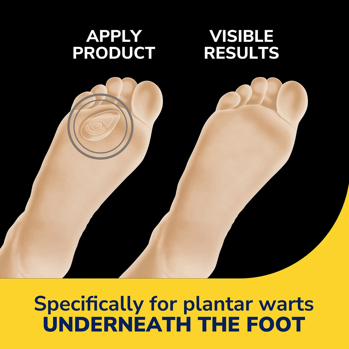 Plantar Wart Remover Seal & Heal Bandage with Hydrogel Technology