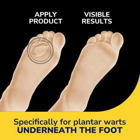 Plantar Wart Remover Seal & Heal Bandage with Hydrogel Technology