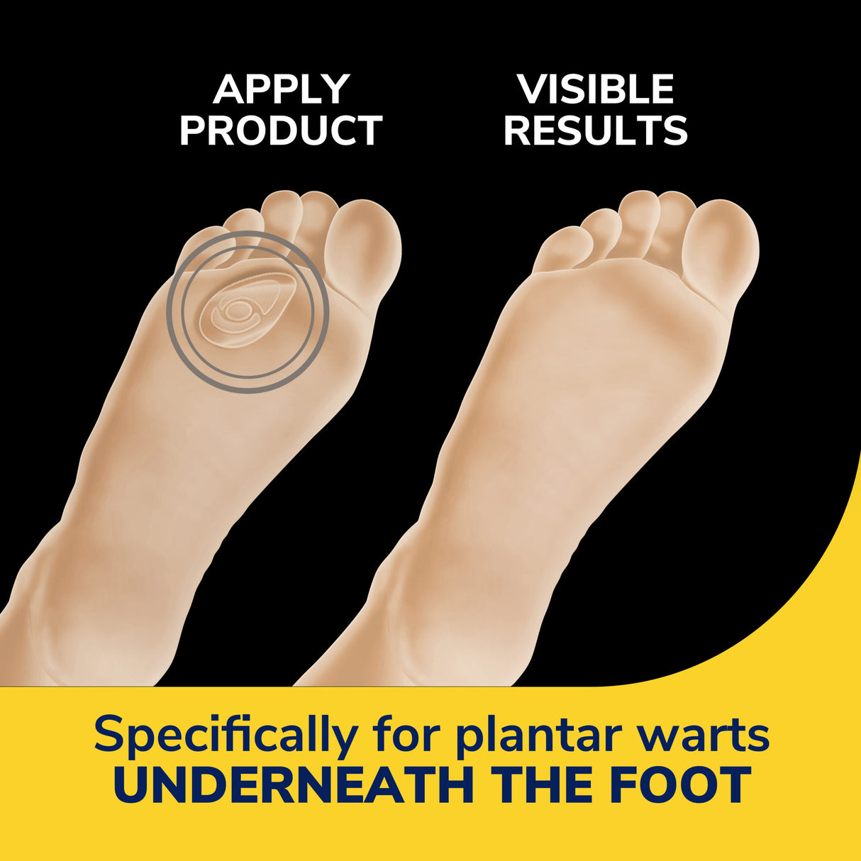 image of specifically for plantar warts underneath the foot