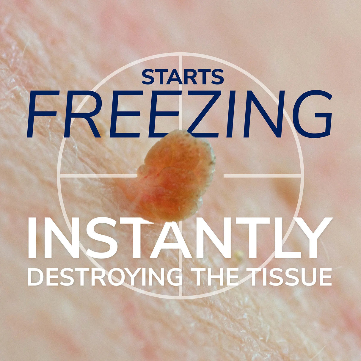 Freeze Away® Skin Tag Remover