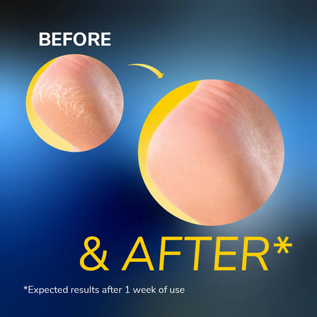 Before and after foot skin comparison with visible dry, flaky texture