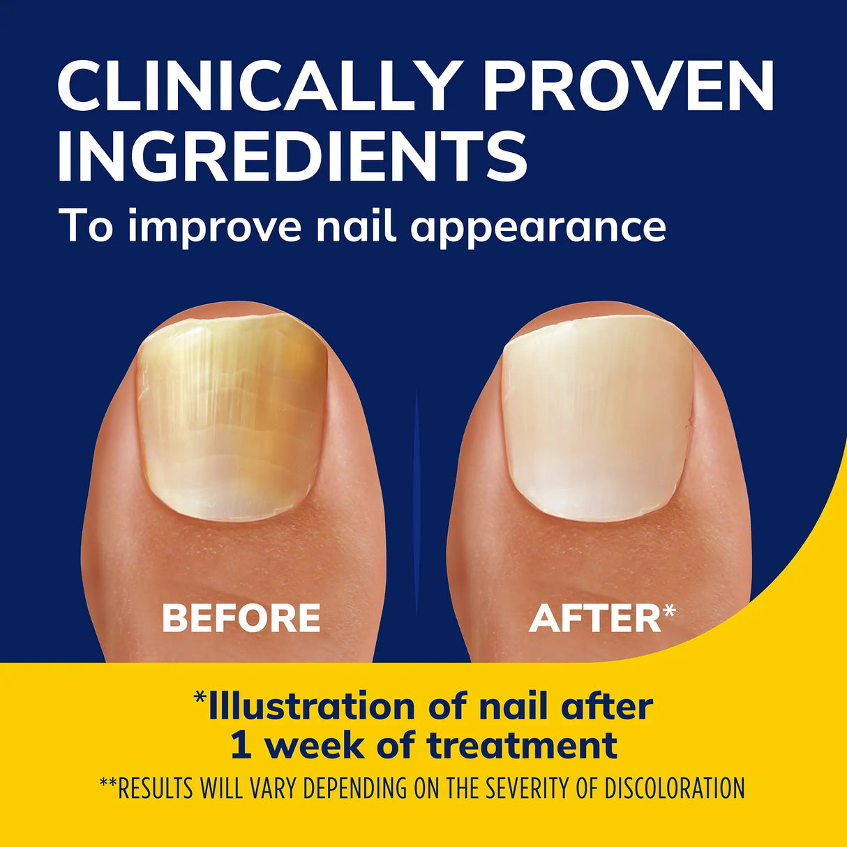 Fungal Nail Revitalizer Kit with Light-Activated Therapy