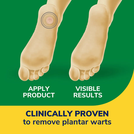 Plantar wart remover instructions graphic with foot and circular disc on skin